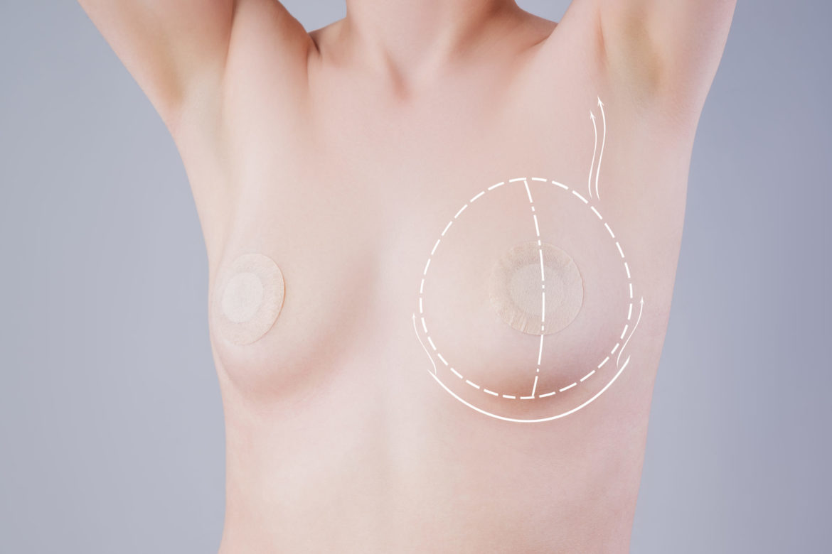 Breast augmentation, woman with nipple stickers and dotted line, plastic surgery and aesthetic medicine concept