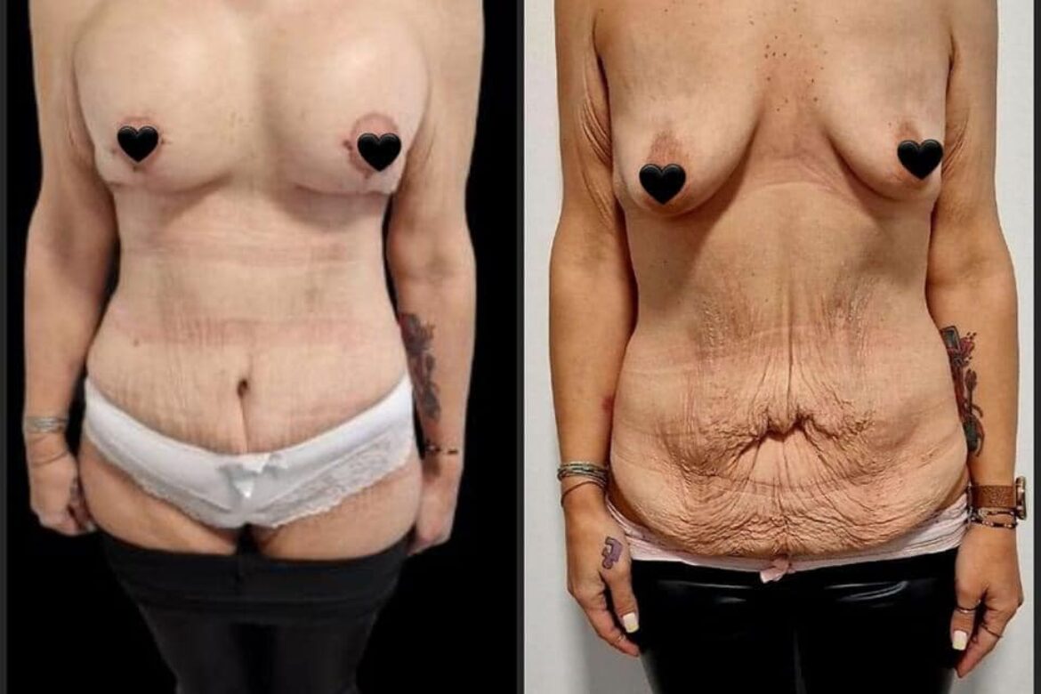 Mastopexie si augmentare cu implanturi siAbdominoplastie23