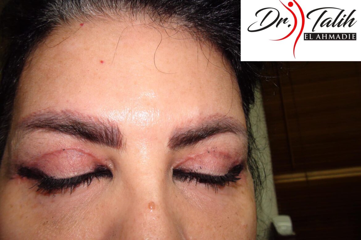 blefaroplastie