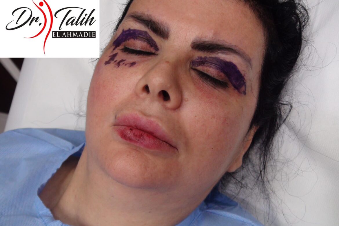 blefaroplastie inainte